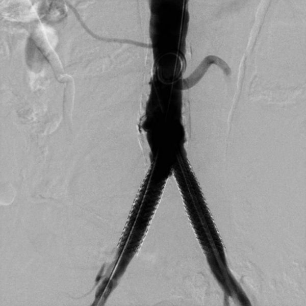 Стентирование подвздошных артерий в ГКБ №3