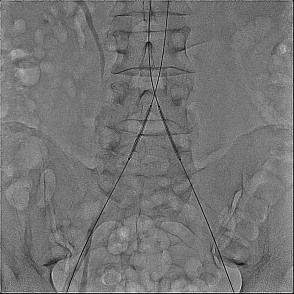 Стентирование подвздошных артерий в ГКБ №3