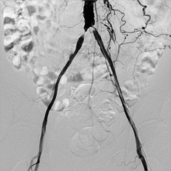 Стентирование подвздошных артерий в ГКБ №3