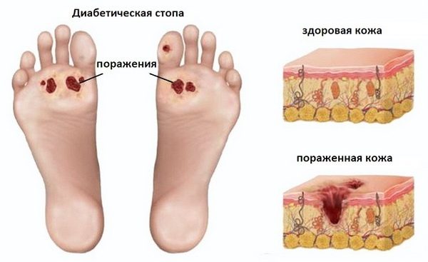 Важная тема! Синдром диабетической стопы