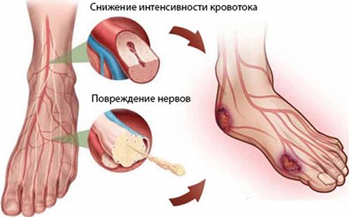 Важная тема! Синдром диабетической стопы