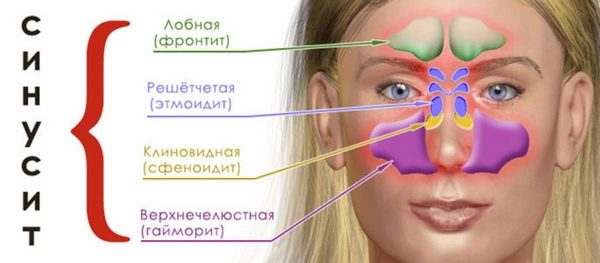 Современное лечение синусита