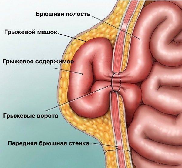 Современное лечение грыж передней брюшной стенки