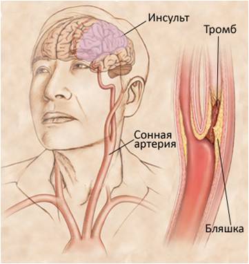 Сосудистая хирургия в борьбе с ишемическим инсультом