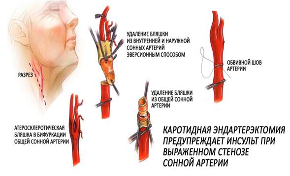 Сосудистая хирургия в борьбе с ишемическим инсультом