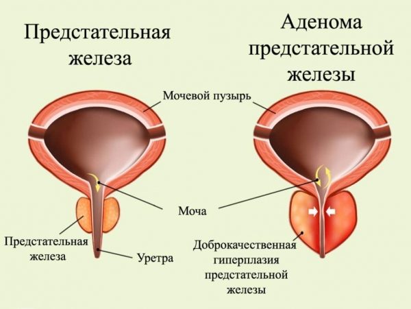 Лечение аденомы предстательной железы