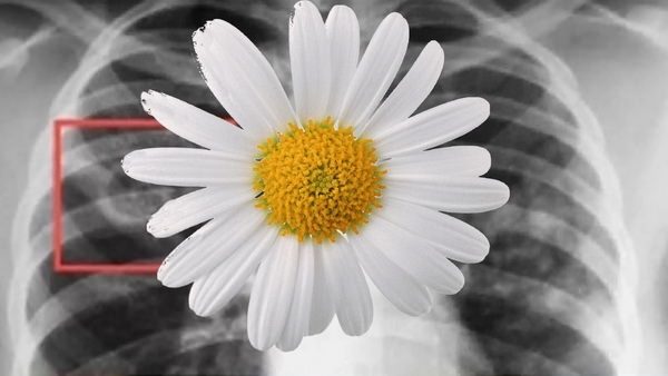 О туберкулезе – в прямом эфире