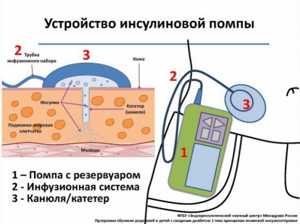 Помпа вместо инъекций - ГКБ Кончаловского