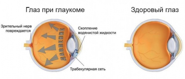 Профилактика глаукомы - ГКБ Кончаловского