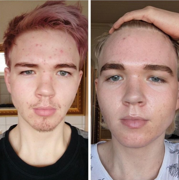 18 людей, которые победили свою проблемную кожу и теперь делятся фотографиями своего преображения