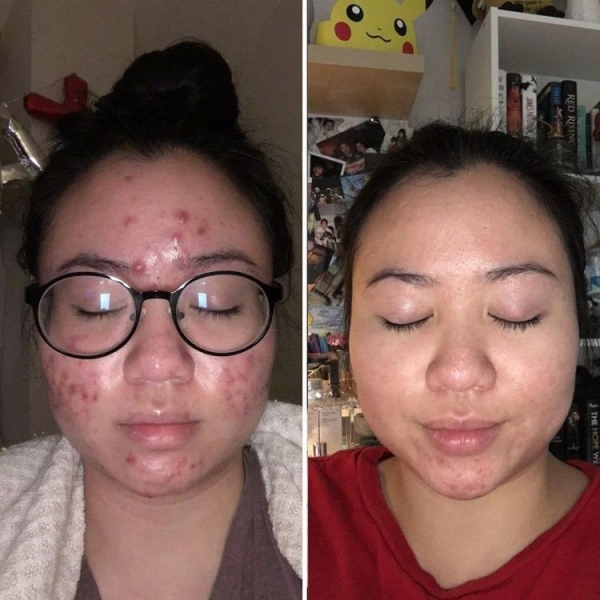 18 людей, которые победили свою проблемную кожу и теперь делятся фотографиями своего преображения