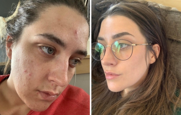 18 людей, которые победили свою проблемную кожу и теперь делятся фотографиями своего преображения