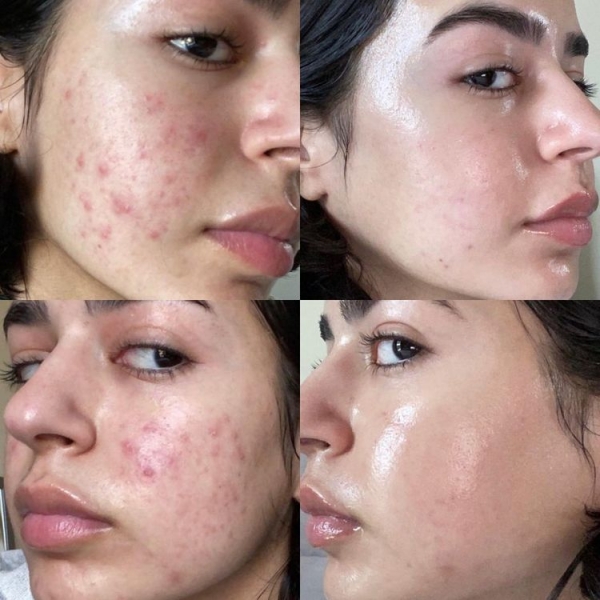 18 людей, которые победили свою проблемную кожу и теперь делятся фотографиями своего преображения