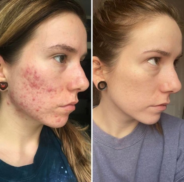 18 людей, которые победили свою проблемную кожу и теперь делятся фотографиями своего преображения