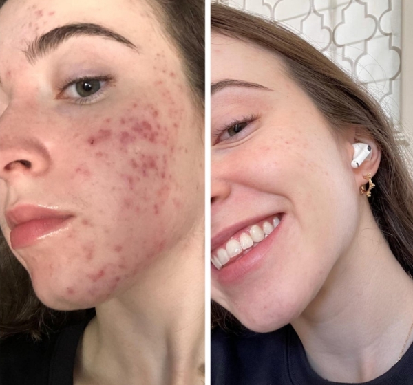 18 людей, которые победили свою проблемную кожу и теперь делятся фотографиями своего преображения