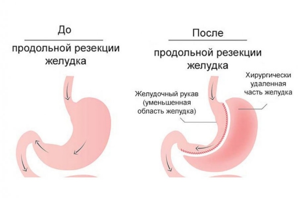Новый вид высокотехнологичной медицинской помощи для пациентов с избыточным весом внедрен в Зеленограде