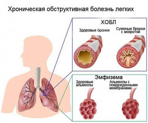 Курение и хроническая обструктивная болезнь легких - ГКБ Кончаловского