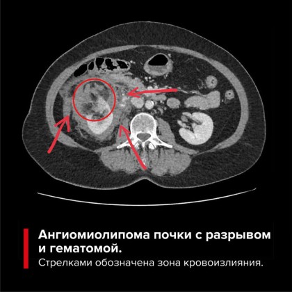 История спасения: ангиомиолипома почки - ГКБ Кончаловского