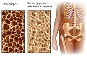 «Тихая» эпидемия XXI века - ГКБ Кончаловского