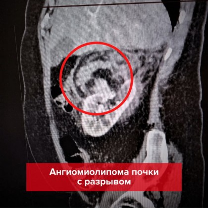 История спасения: ангиомиолипома почки - ГКБ Кончаловского