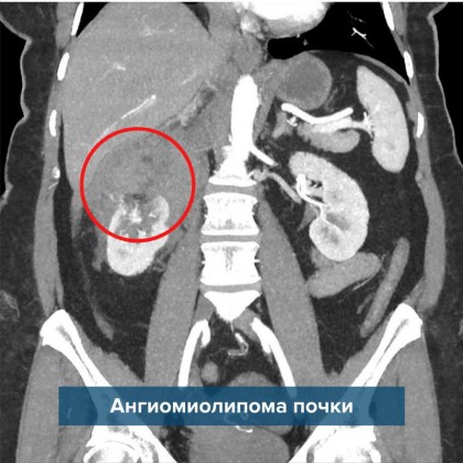 История спасения: ангиомиолипома почки - ГКБ Кончаловского