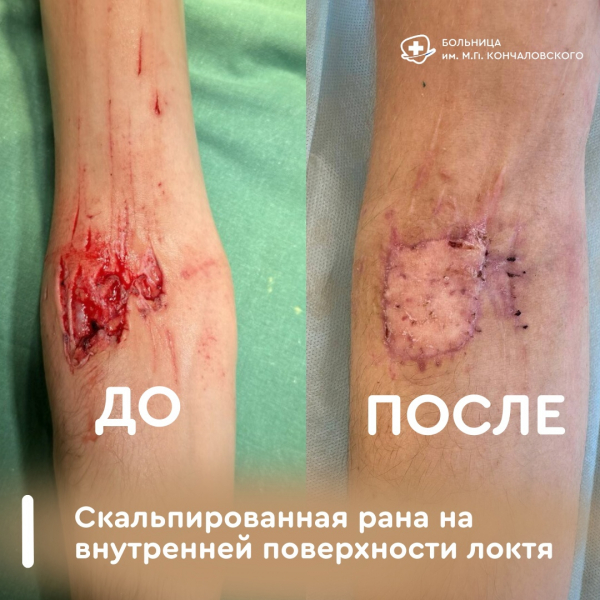 В Детском центре выполнили пересадку кожи молодому пациенту после неудачного падения с питбайка