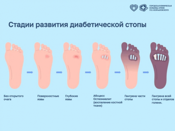 Синдром диабетической стопы - ГКБ Кончаловского